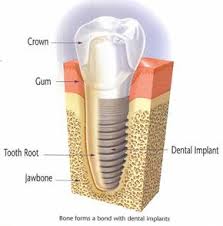 Dental Implant in Victoria BC