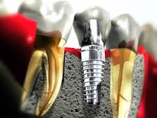 Dental Implants in Victoria BC