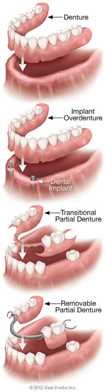 Diagram of removable dentures in Victoria BC