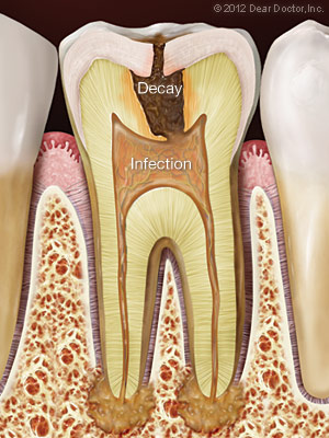 Image of a tooth with decay and infection