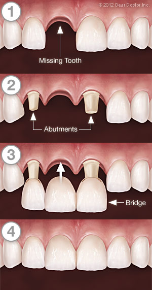 Image of the process of a bridge implant in Victoria BC