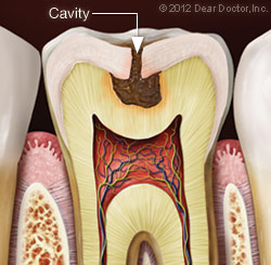 Image of a tooth with a cavity