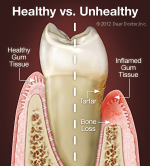 Image of healthy gums and unhealthy gums