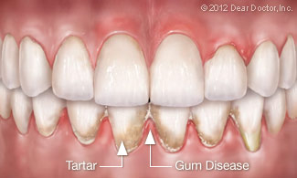 Image of gum disease