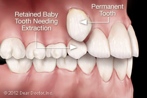 Image of a retained baby tooth in need of a tooth extraction