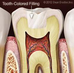 Image of a tooth-colored dental filling in Victoria BC