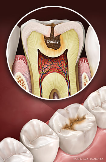 Image of tooth decay