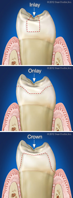 Image of dental inlay and dental onlays in Victoria BC