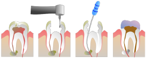 How Root canals in Victoria BC are done