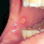 photo of Canker Sore treatment in Victoria BC