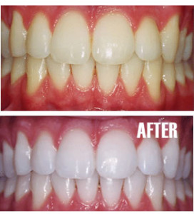 Before and after teeth whitening in Victoria BC