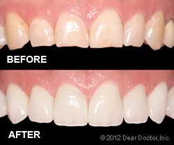 Before and after dental veneer in Victoria BC